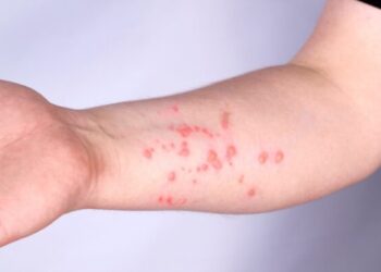 Com 709 casos de Mpox no Brasil, Ministério da Saúde convoca reunião extraordinária